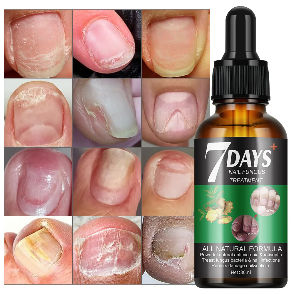 7 DAYS Nail Fungus Treatment Liquid